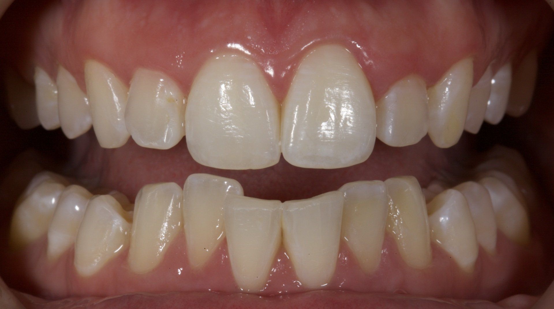 Close-up of a mouth showing aligned upper and lower front teeth with a noticeable gap between the central incisors