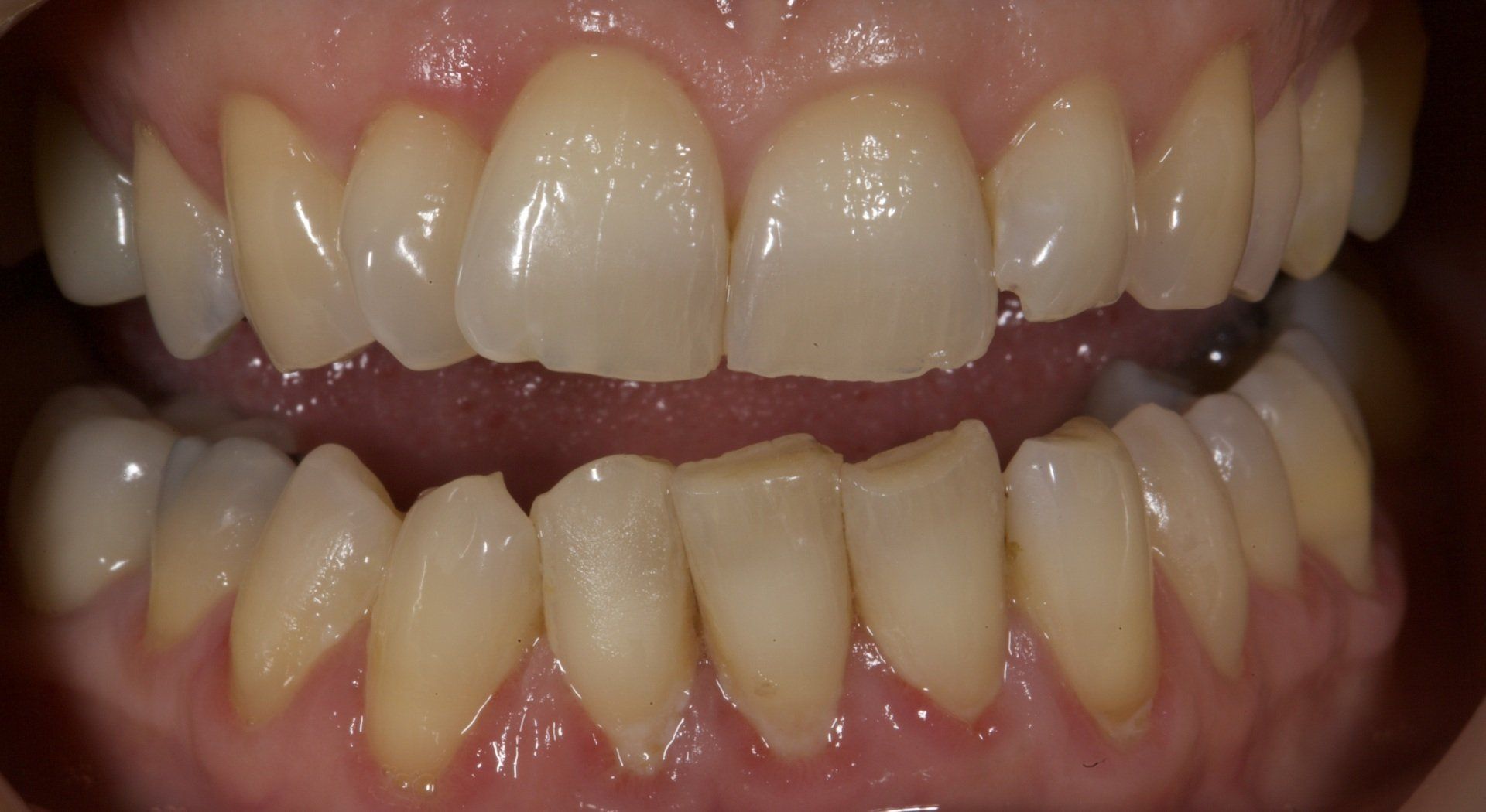 Close-up of a smiling mouth showing upper and lower teeth with a gap between the front teeth
