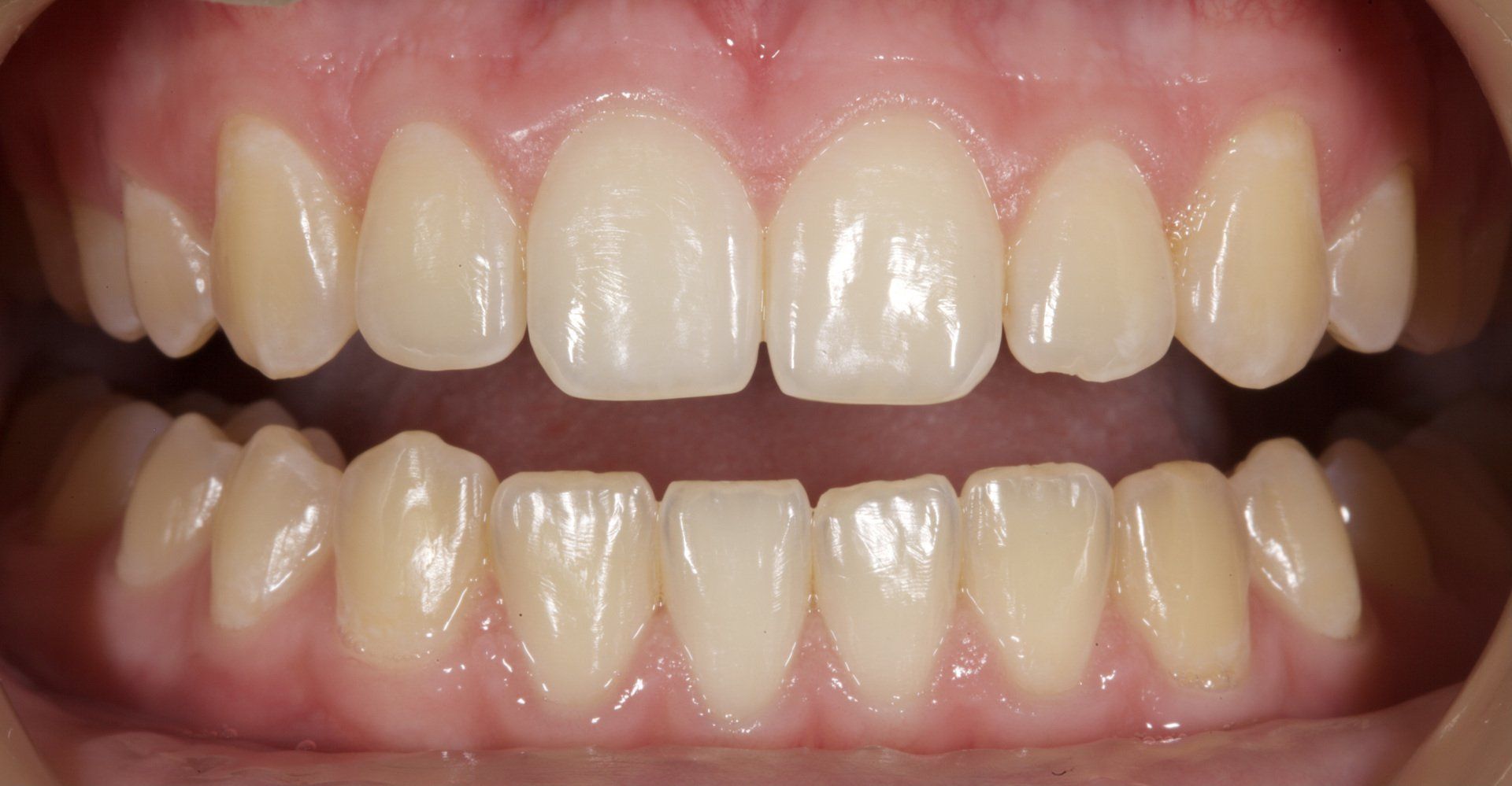 Close-up of a mouth with visible teeth and gums, upper and lower front teeth centered.