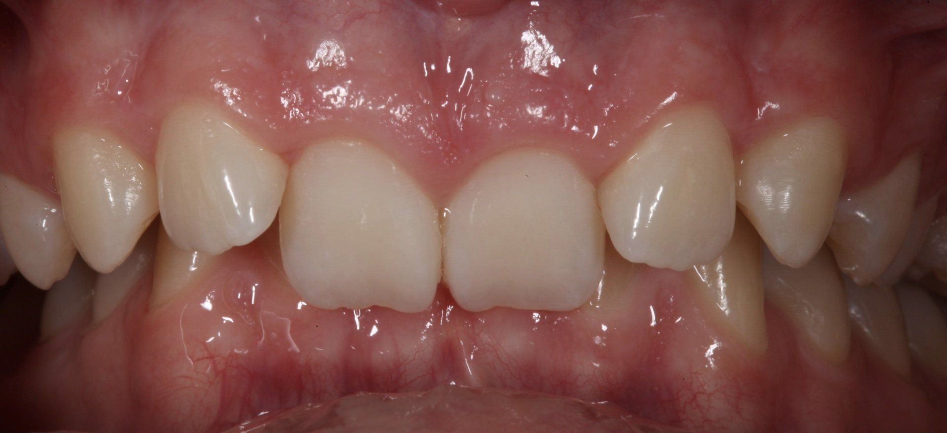 Close-up of upper and lower front teeth with a small gap and pink gums