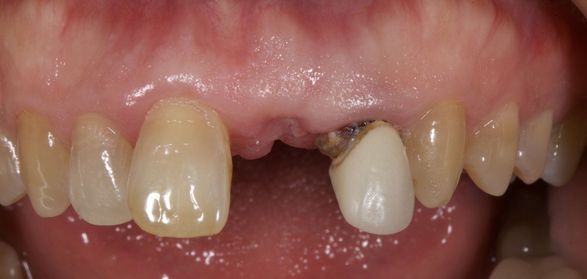 Close-up of teeth with two front teeth capped in white dental crowns
