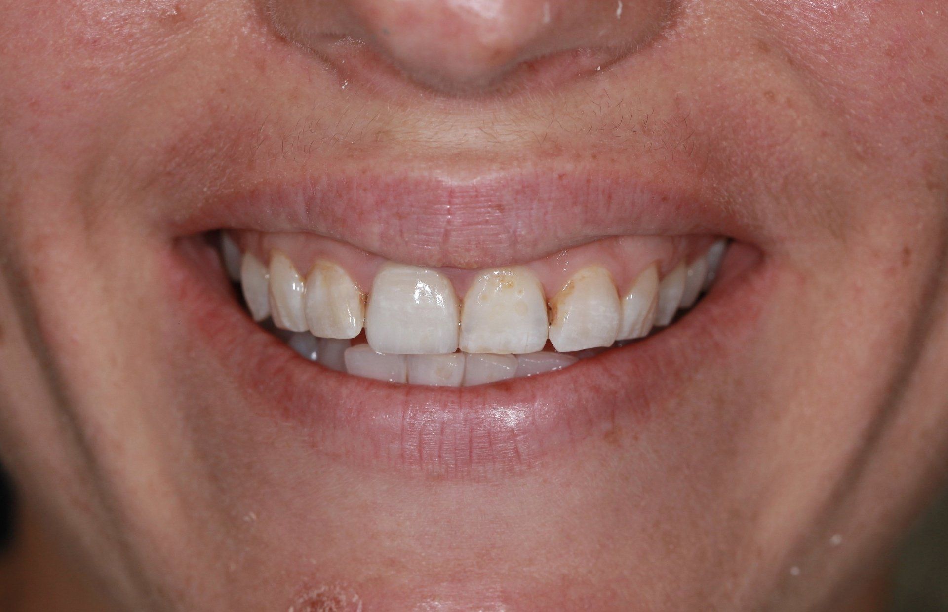 Close-up of a smiling mouth with visible teeth and a slight gap between the front teeth