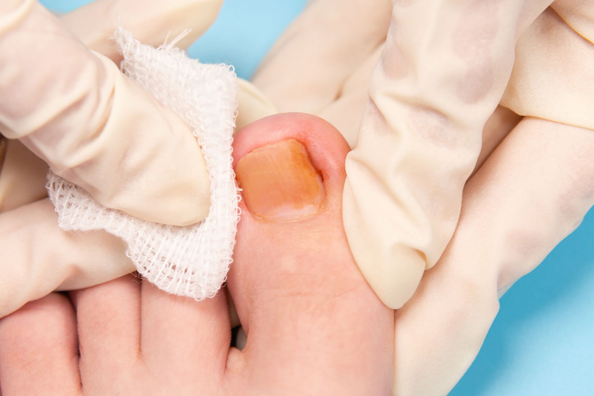 Hands in gloves cleaning a toe with an orange-tinged toenail, gauze and gloves.
