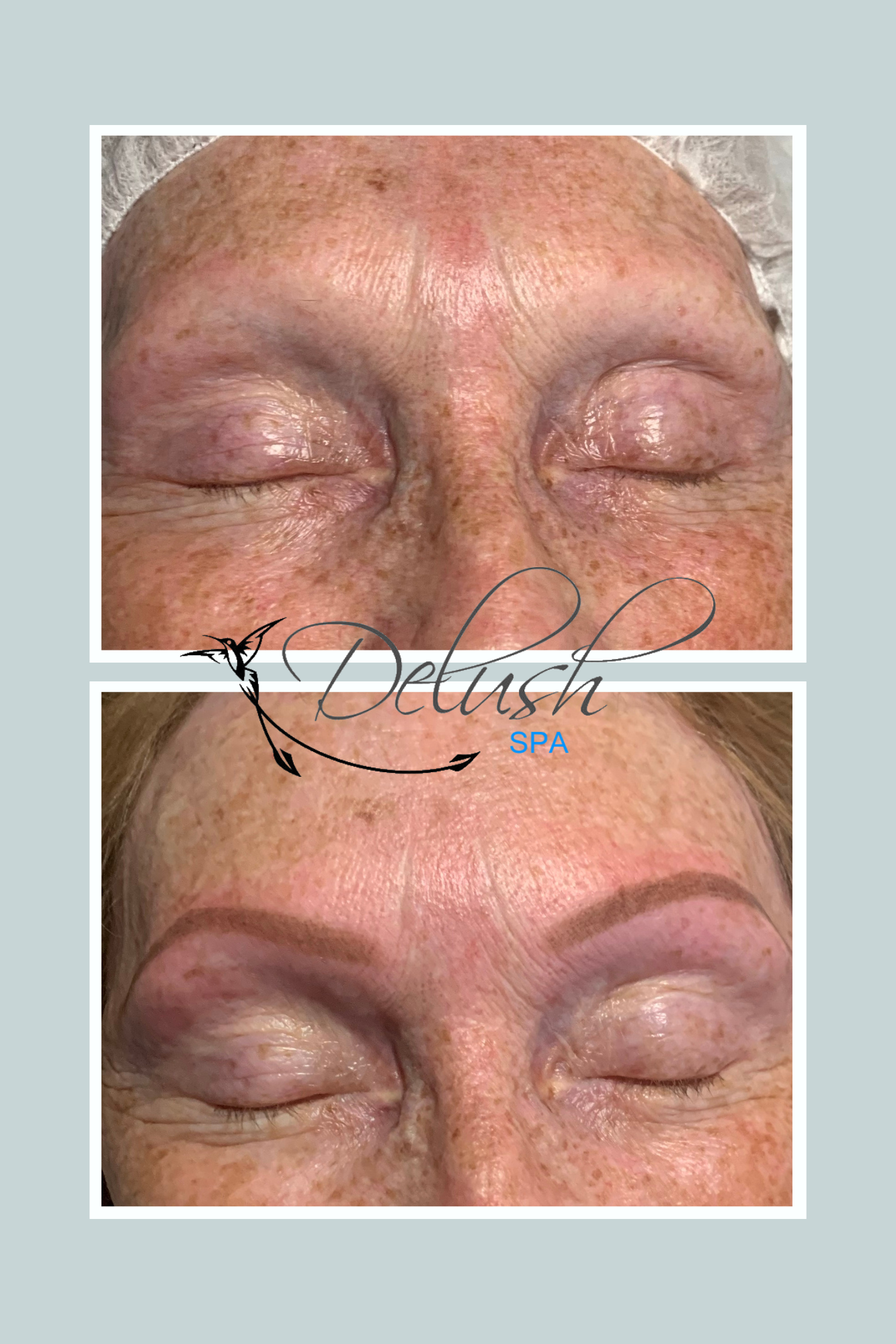 Before-and-after close-up of closed eyes and forehead, showing smoother skin and reduced wrinkles.