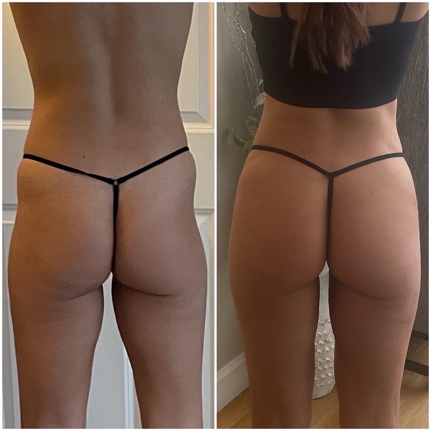 Before and after views of a person's buttocks. Left image: looser skin. Right image: firmer, more contoured.