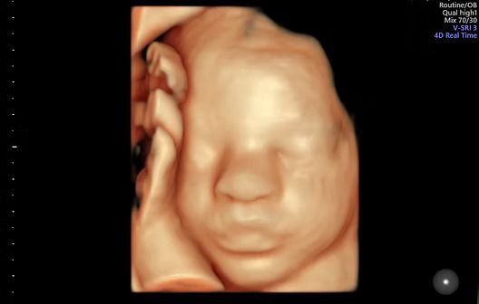 3D ultrasound image of a fetus’s face, with hand near the cheek, on a black background