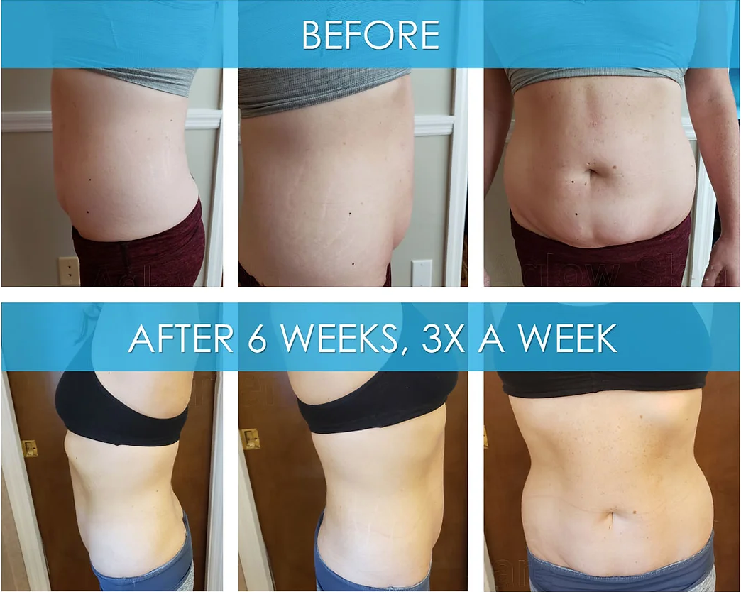 Before and after picture of a stomach to show the benefits of MyLipo Laser Body Sculpting at Fit n Tan St. Louis
