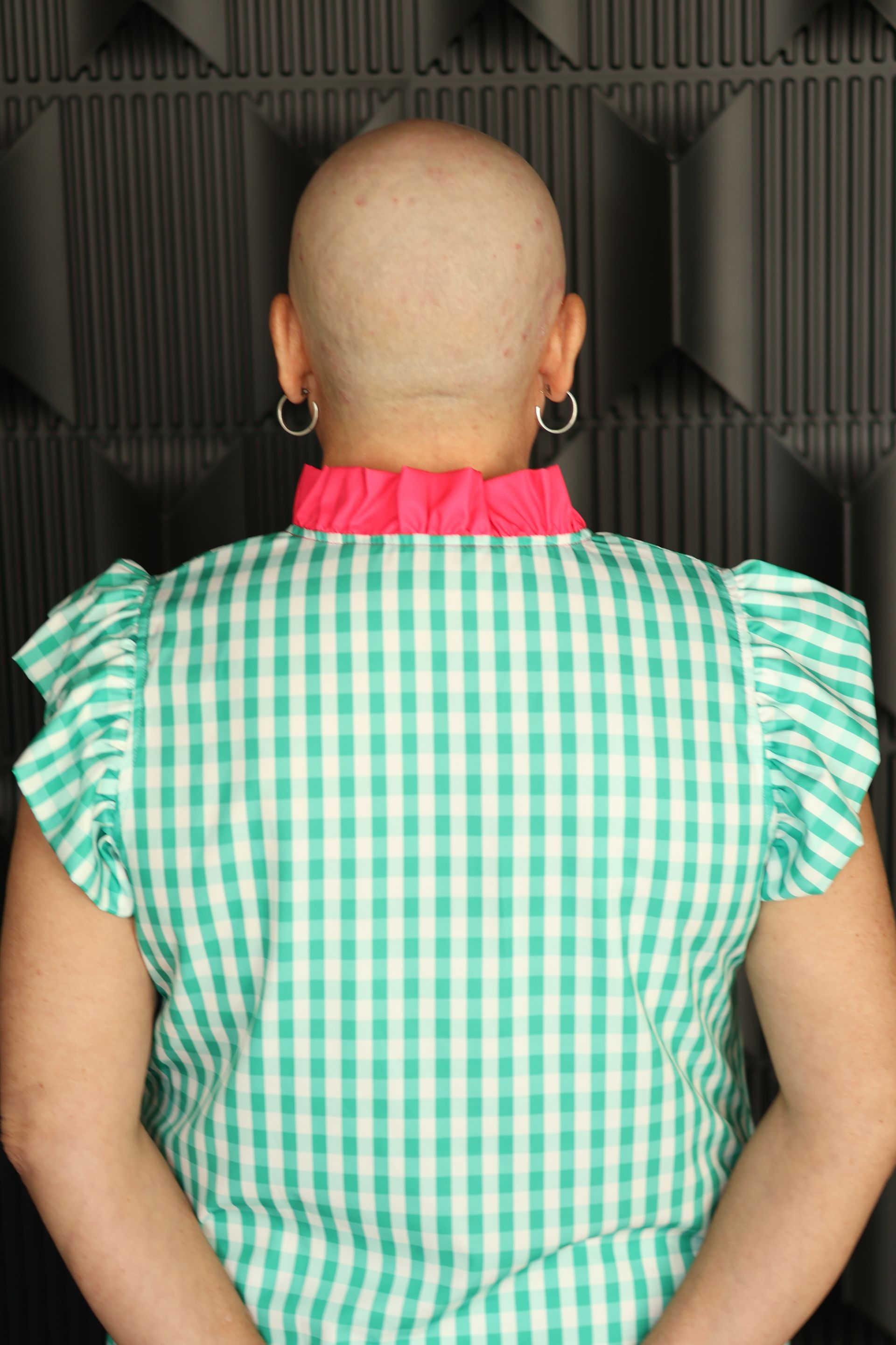 Back view of cancer-related hair loss before custom wig fitting