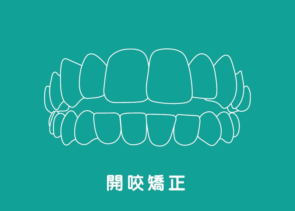 開咬矯正Open-bite
