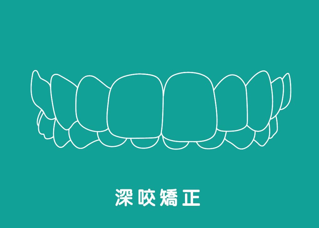 Deep-bite