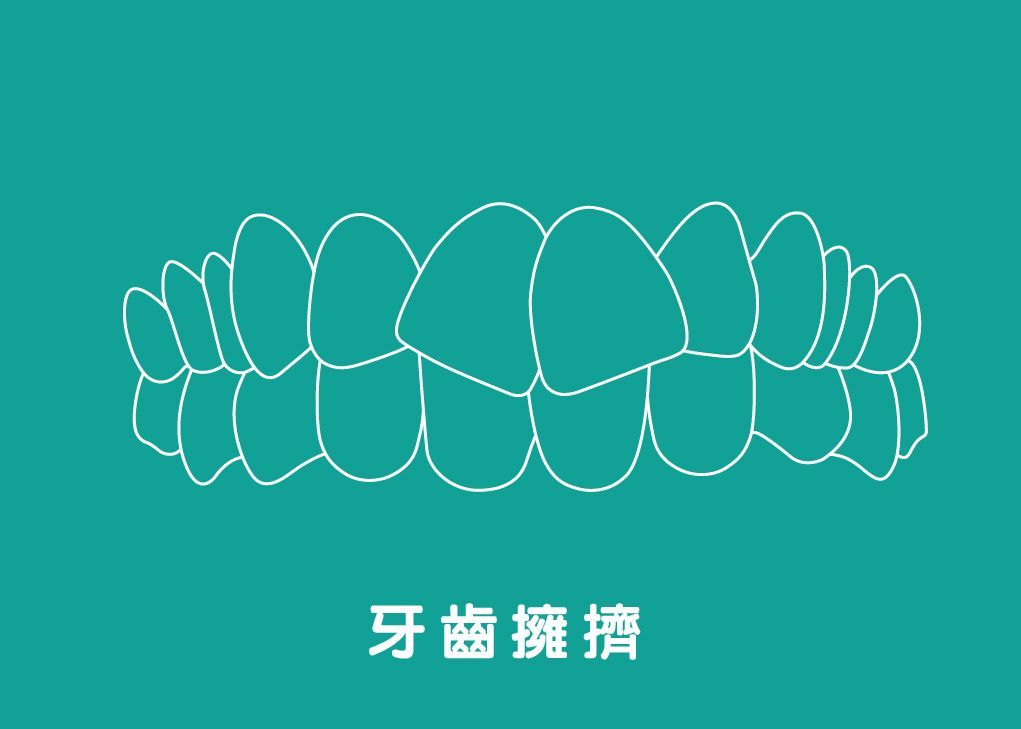牙齒擁擠Overcrowded