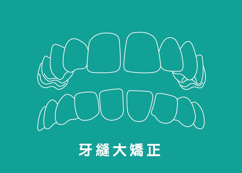 牙縫過大Gapped teeth