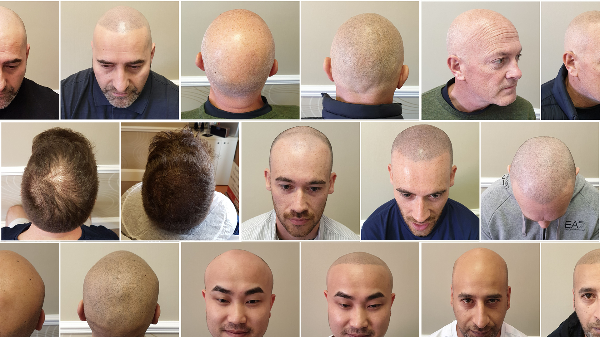 man getting smp procedure consultation