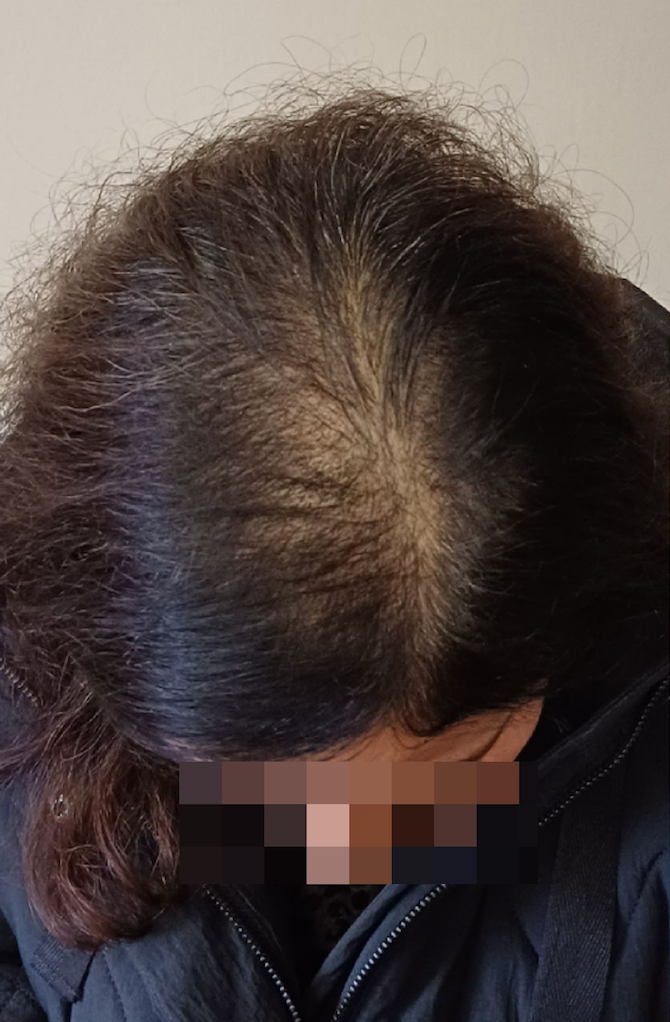 Scalp Micropigmentation for hair thinning before