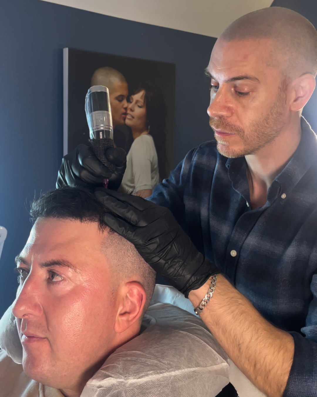 smp procedure on hair transplant