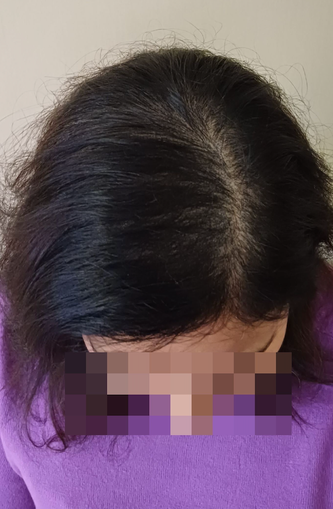 Scalp Micropigmentation for hair thinning after