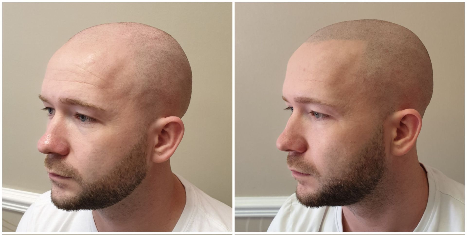 Scalp Micropigmentation Services for Full-Head Density Work