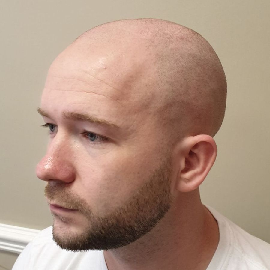 male pattern baldness SMP before