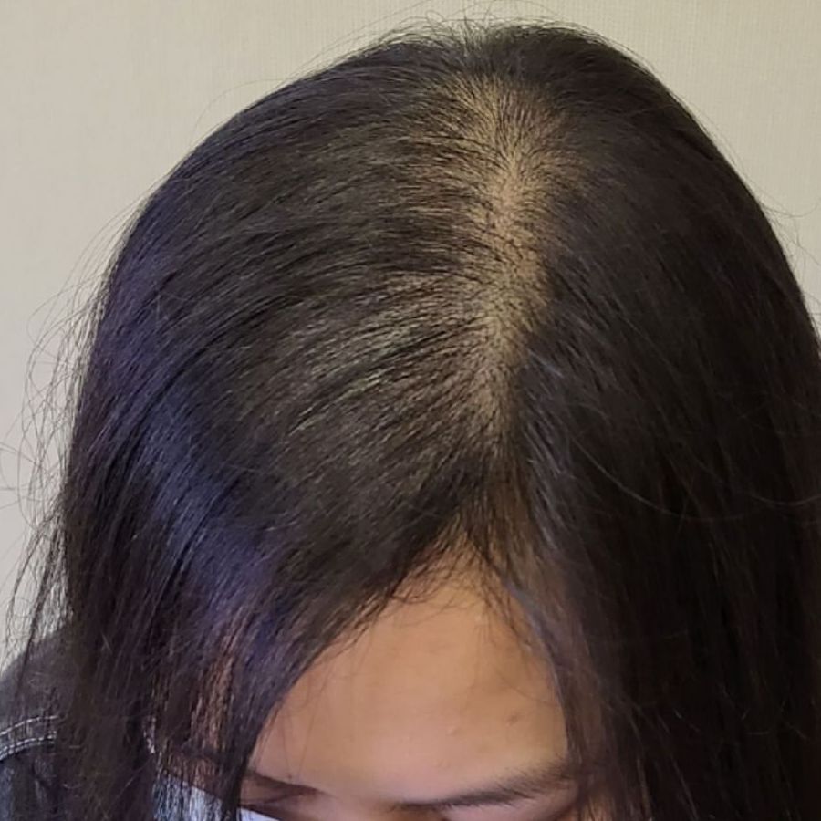 SMP for hair thinning before after