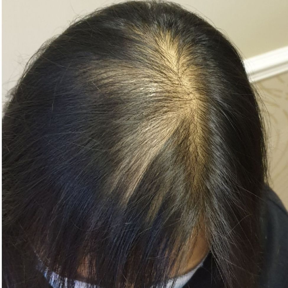 SMP for hair thinning before