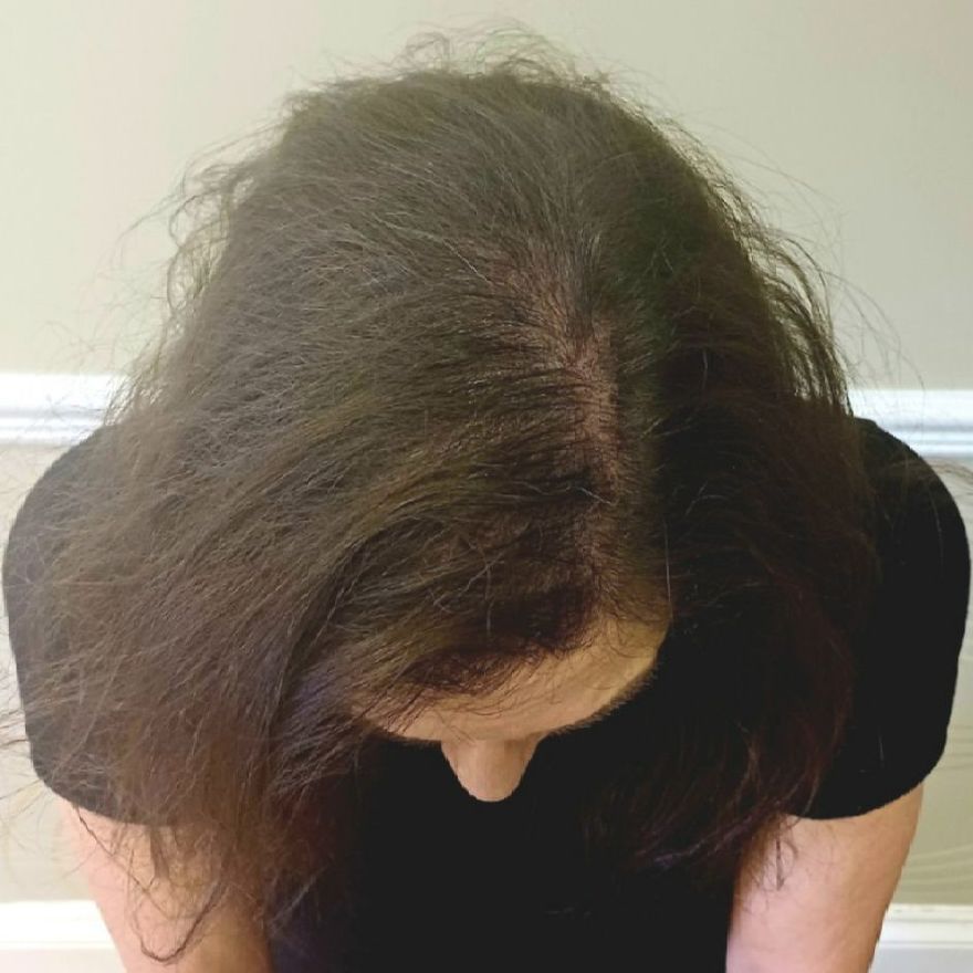 Hair thinning SMP correction after