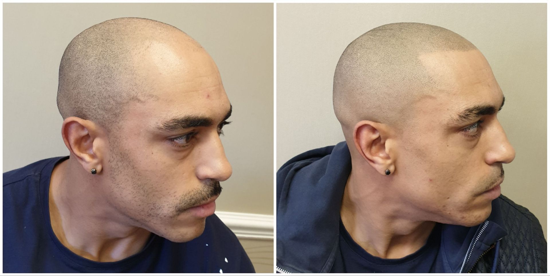 Male Pattern Baldness SMP Result
