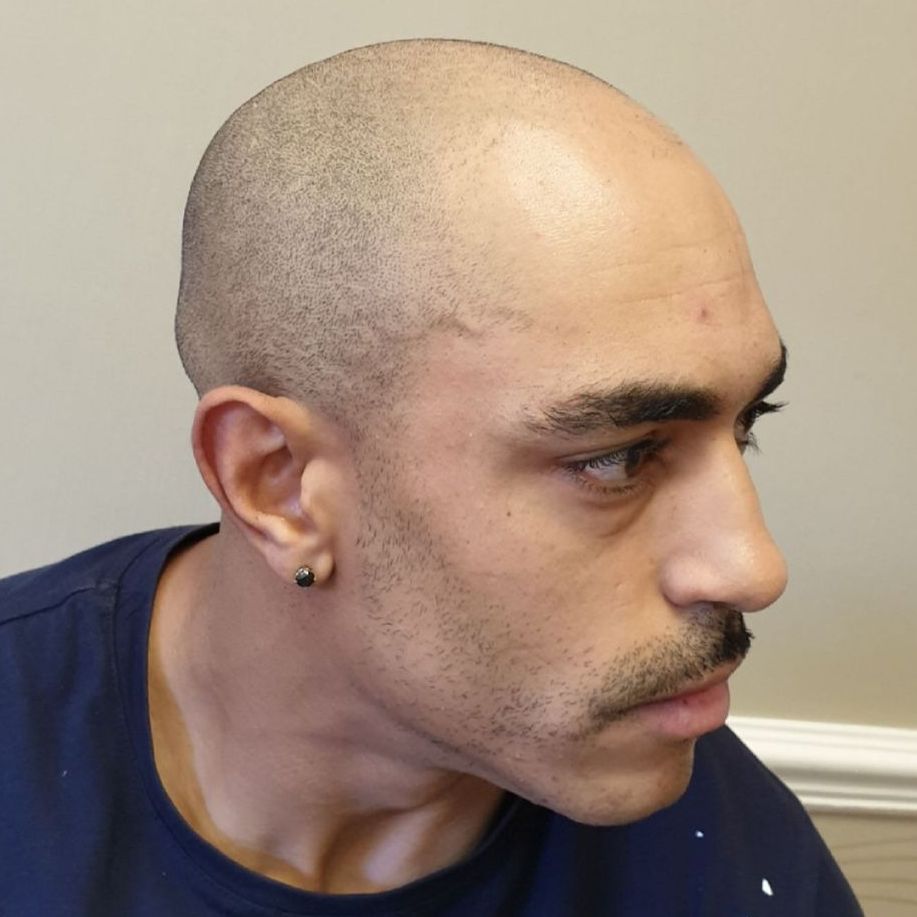 Scalp Micropigmentation for Male Pattern Baldness Before