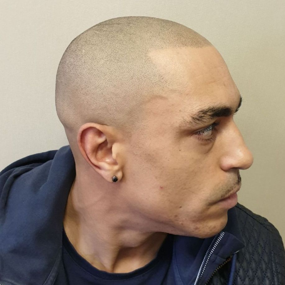 Scalp Micropigmentation for Male Pattern Baldness After