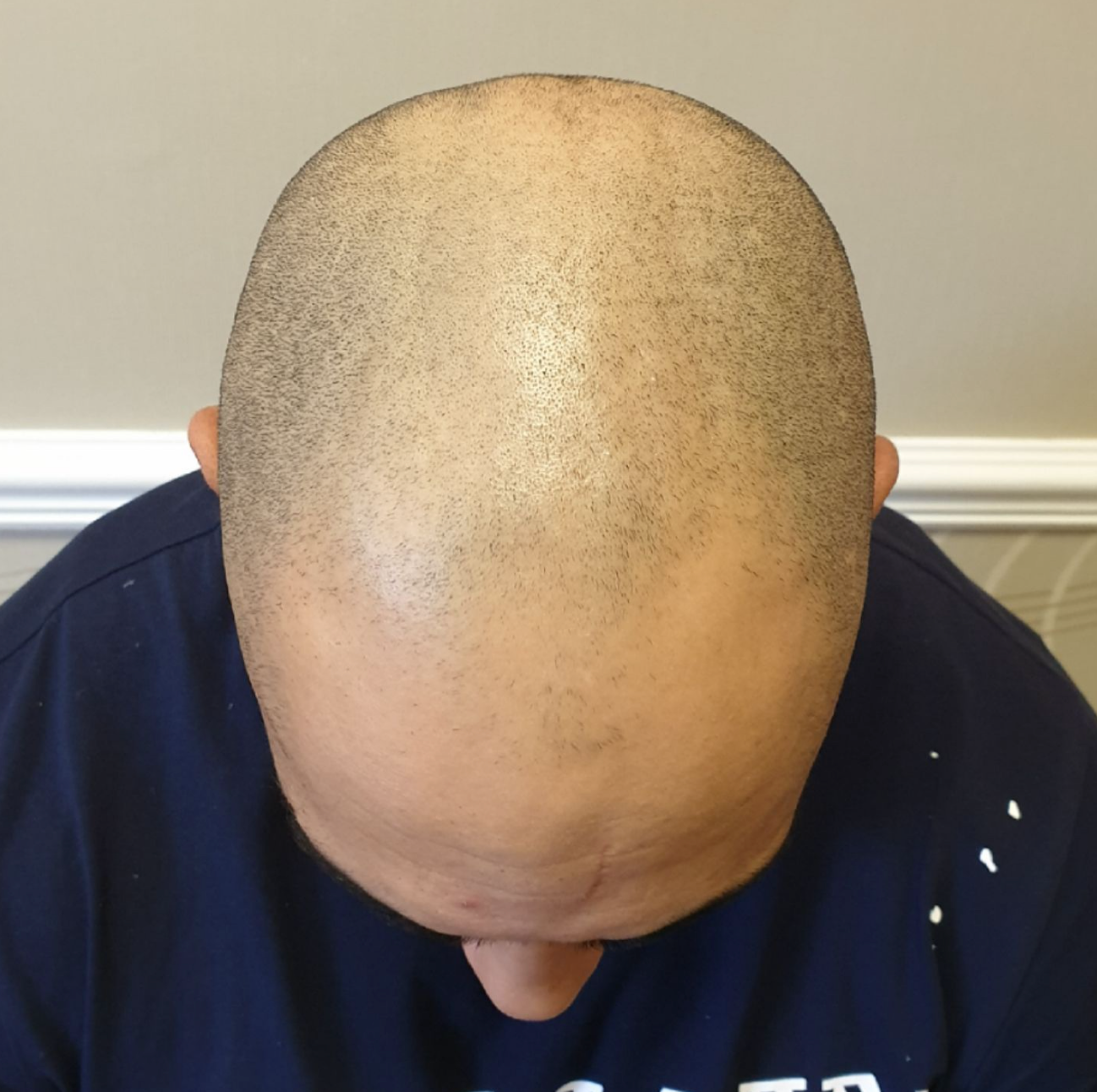 Hairline tattoo before