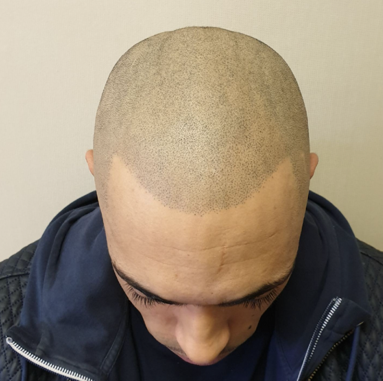 Hairline tattoo after