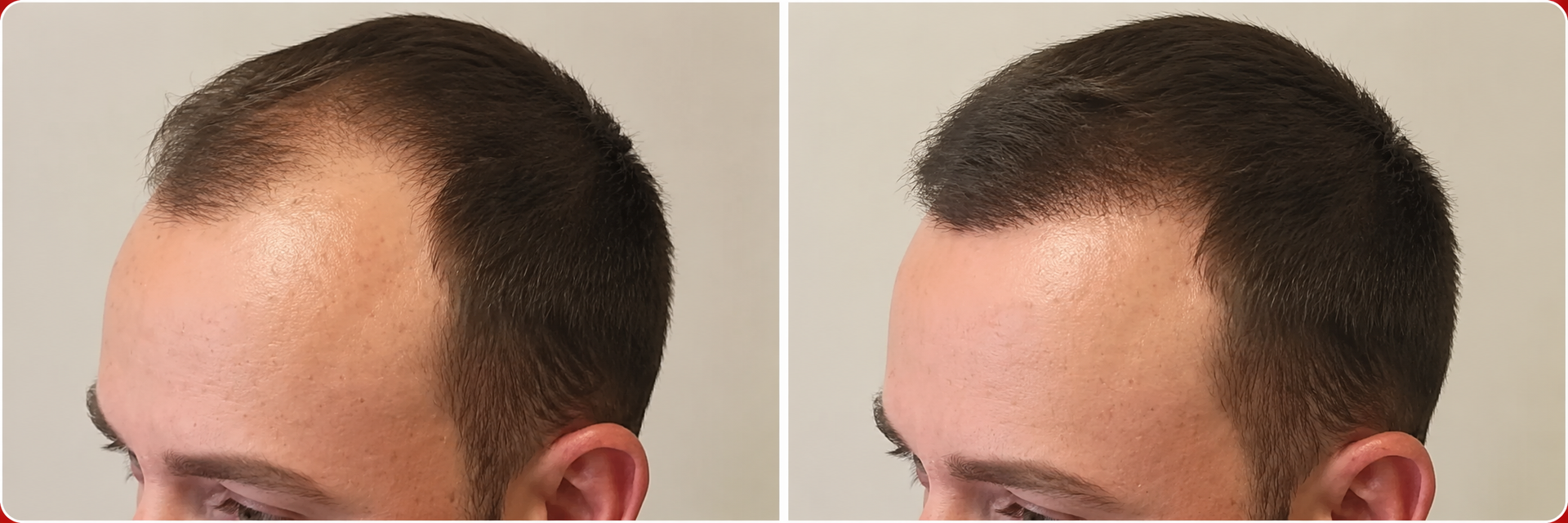 Scalp micropigmentation hairline