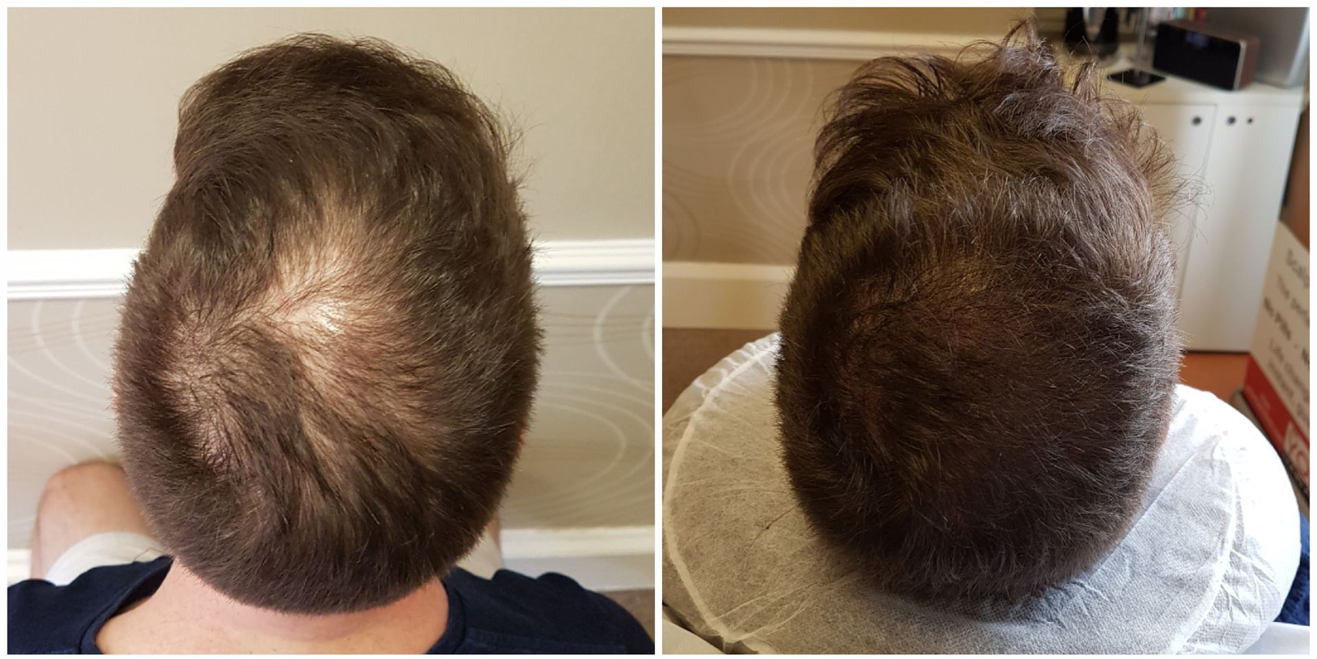 2 pictures of a before and fter for scalp micropigmentation of a mans head
