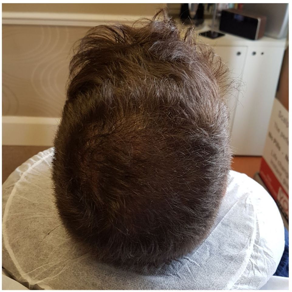 SMP for crown hair thinning after