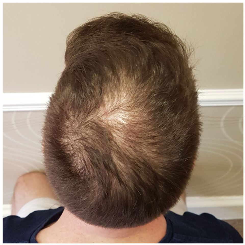 SMP for crown hair thinning before