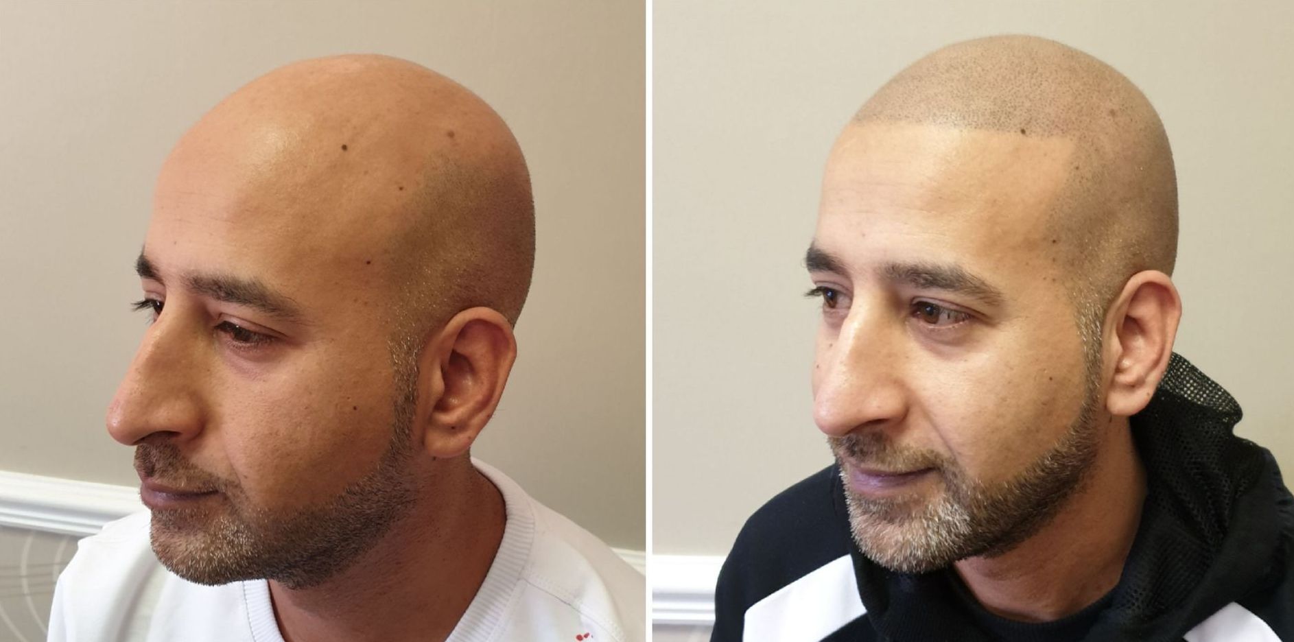 SMP treatment for men
