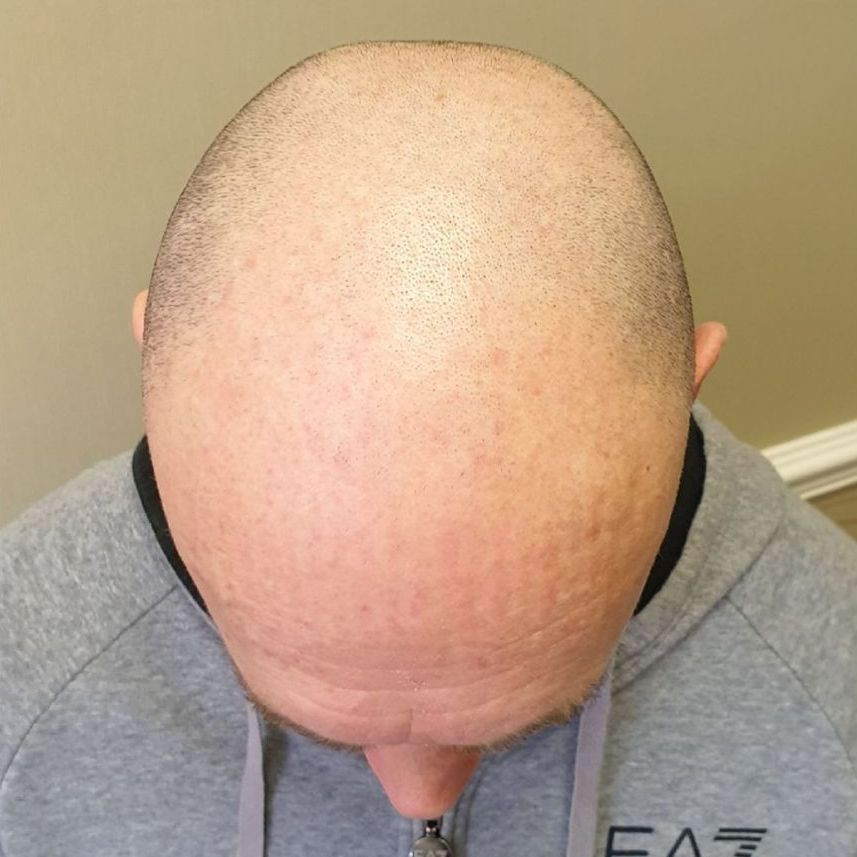 Male pattern baldness scalp pigmentation before