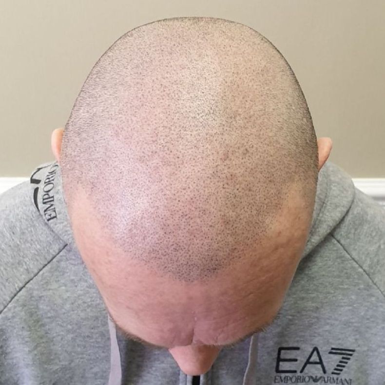 Male pattern baldness scalp pigmentation after