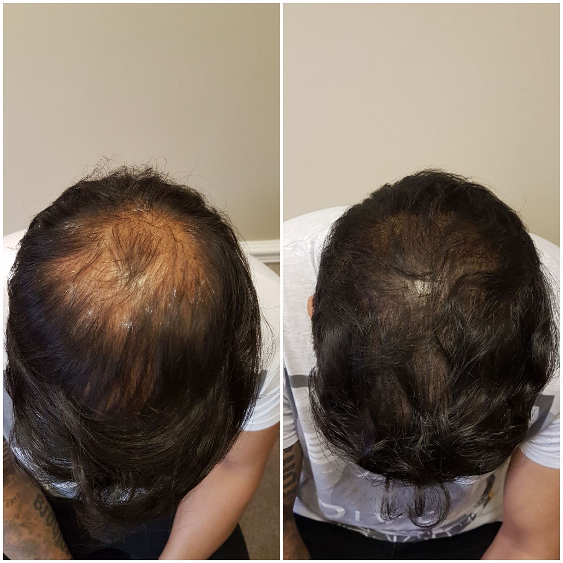 Before and after SMP results for male pattern baldness