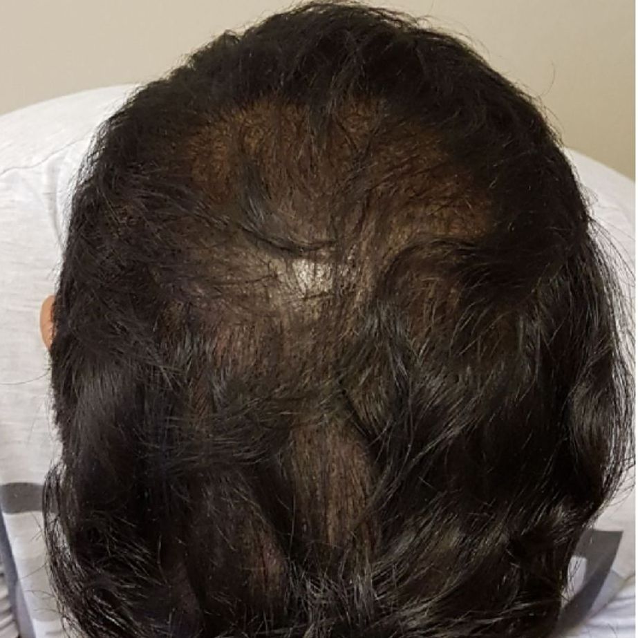 Hair thinning SMP transformation after