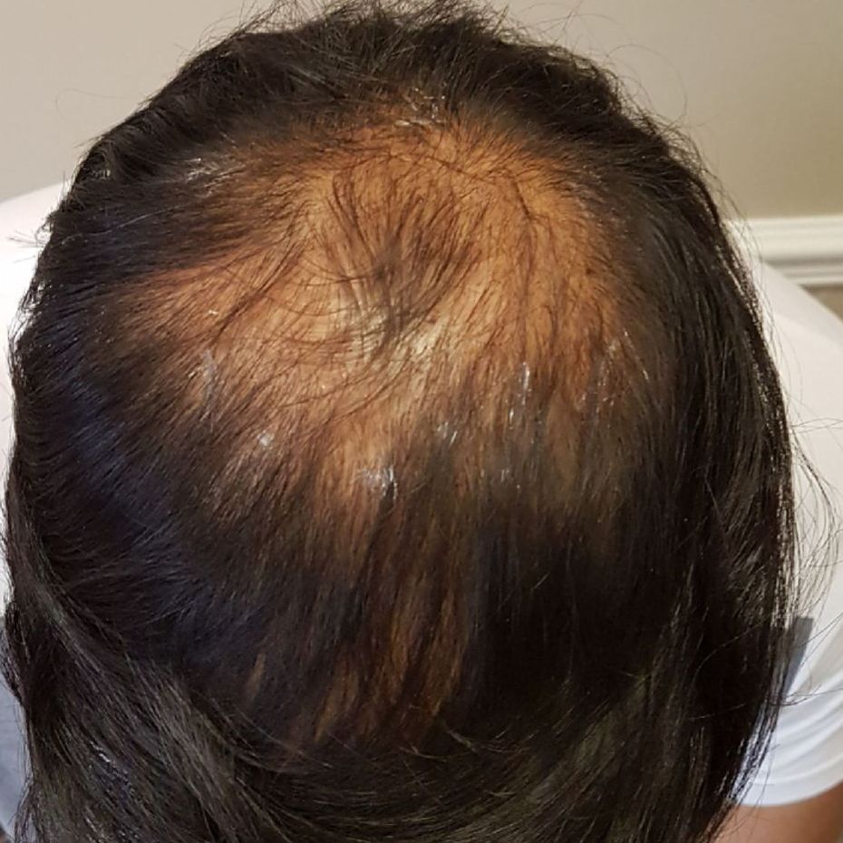 Hair thinning SMP transformation before