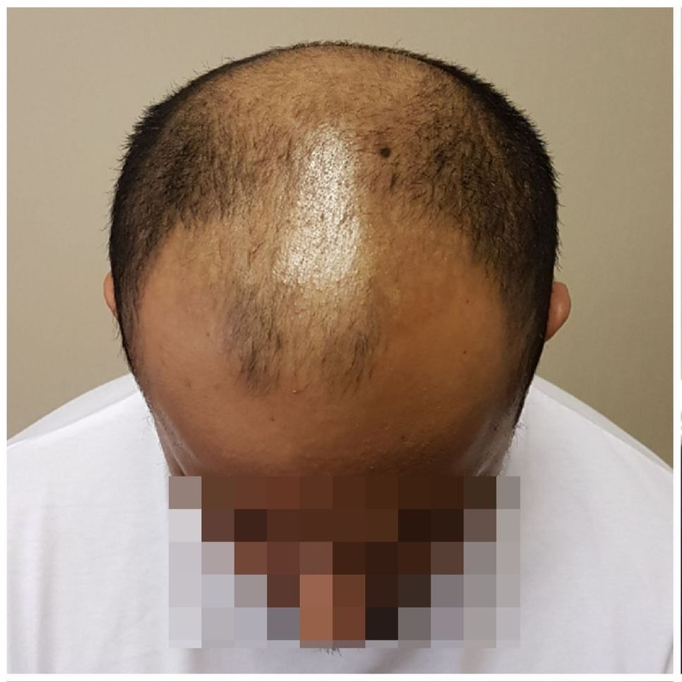 SMP For Male Pattern Baldness Before