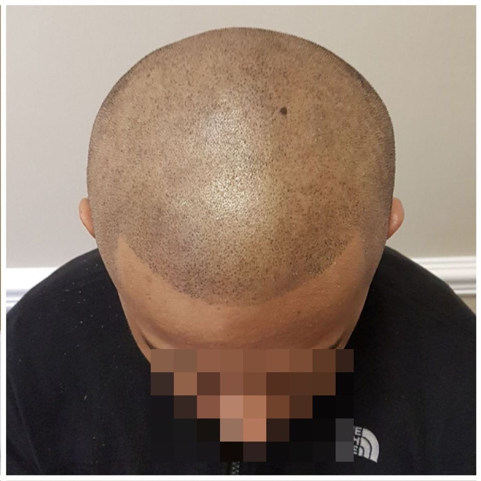 SMP For Male Pattern Baldness After