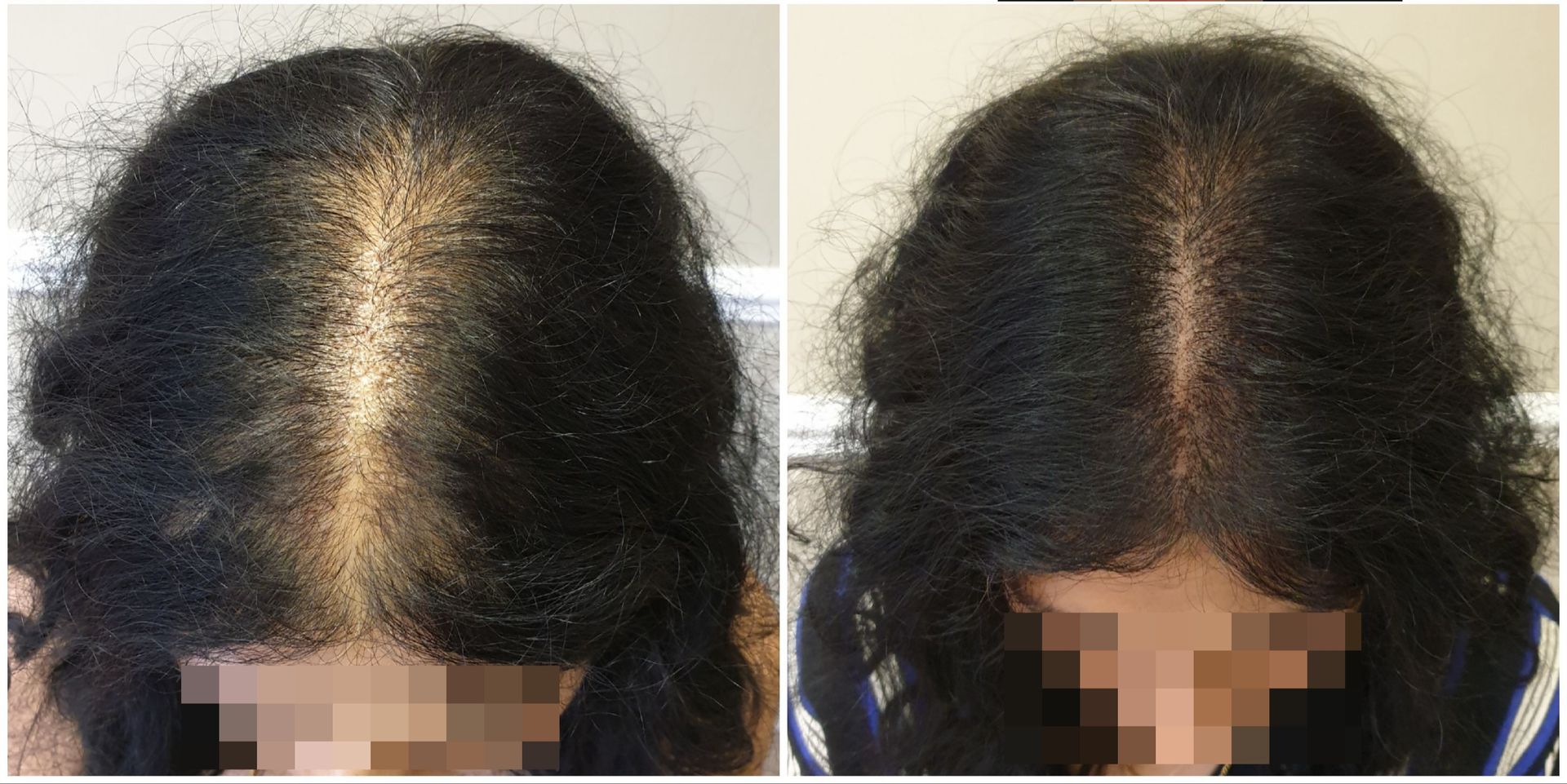 Before and after results on woman SMP