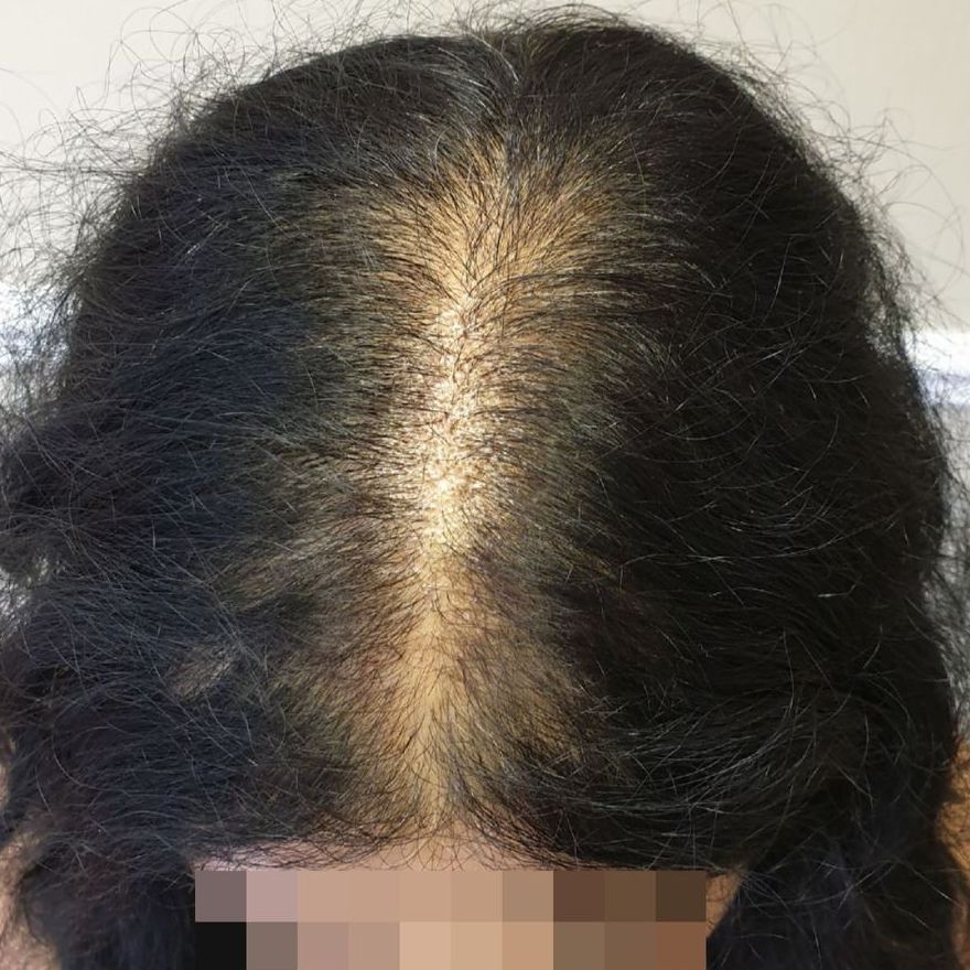 scalp micropigmentation hair thinning transformation before