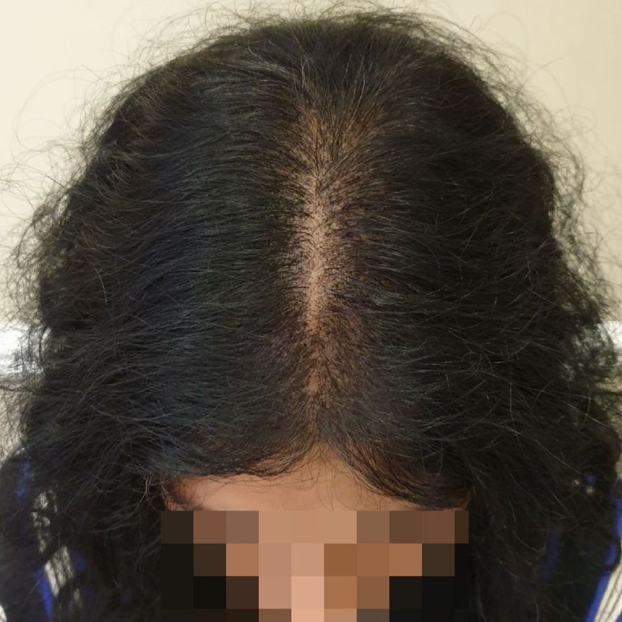 scalp micropigmentation hair thinning transformation after
