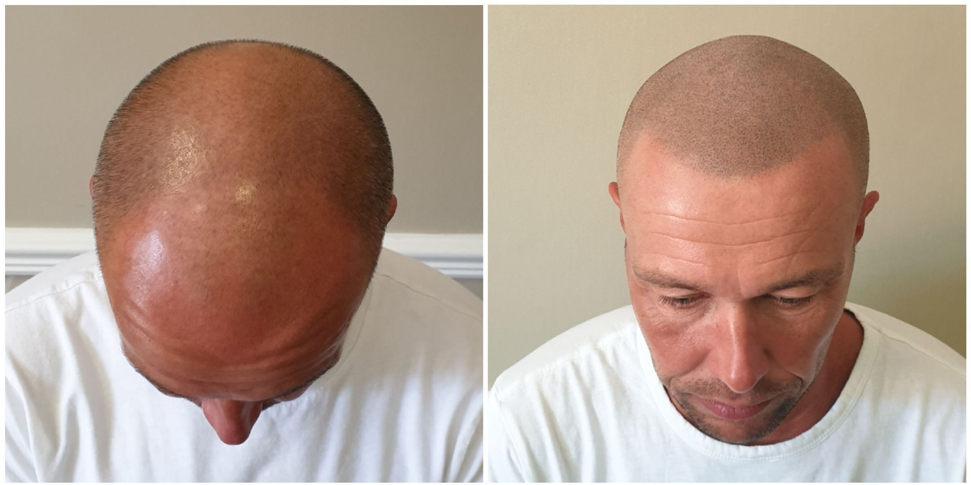 Gradual Hair Loss SMP Result