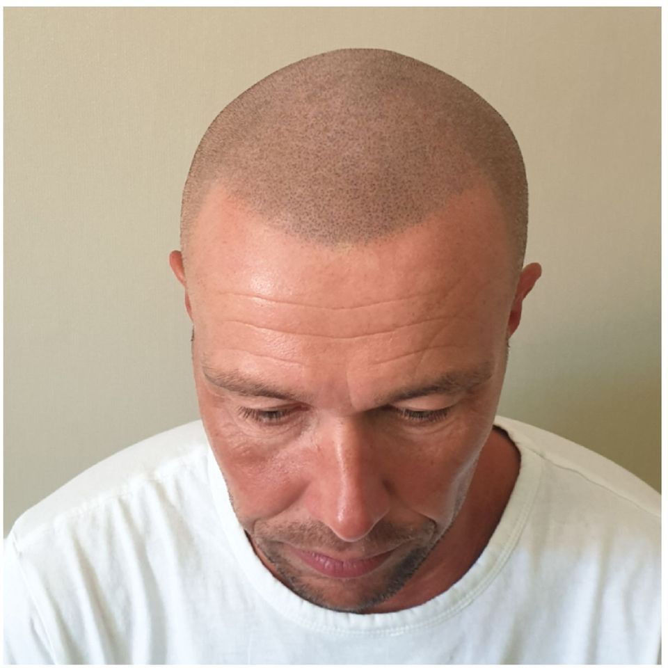 Scalp Micropigmentation for hair loss after
