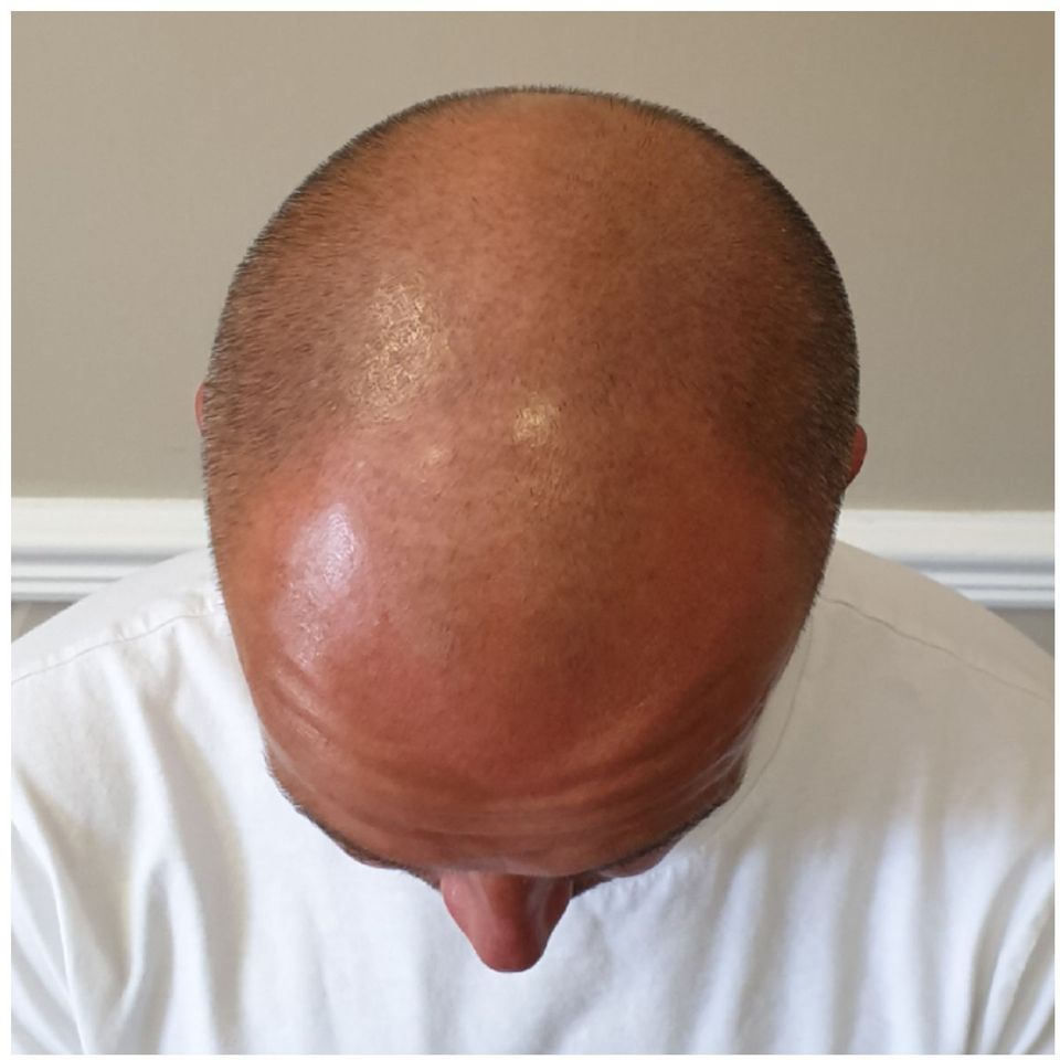 Scalp Micropigmentation for hair loss before