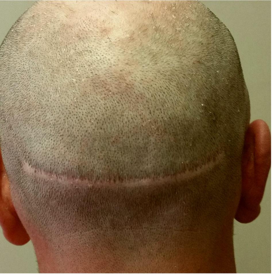 SMP for Head Scarring Before