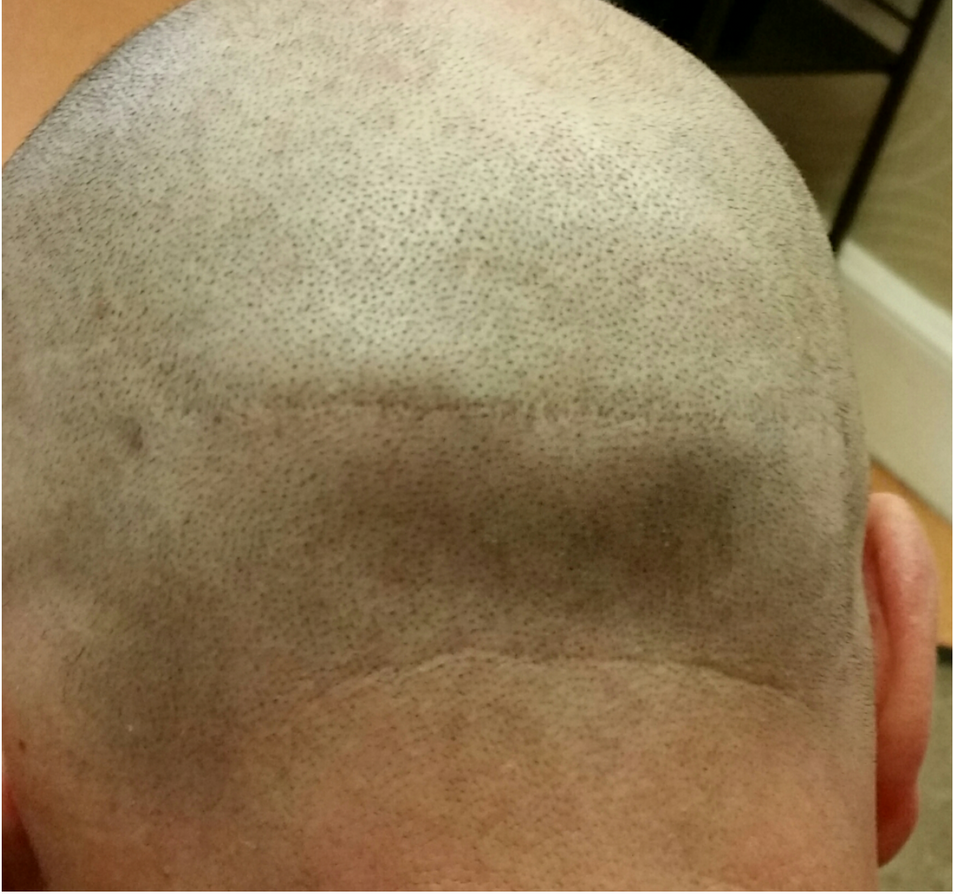 SMP for Head Scarring After